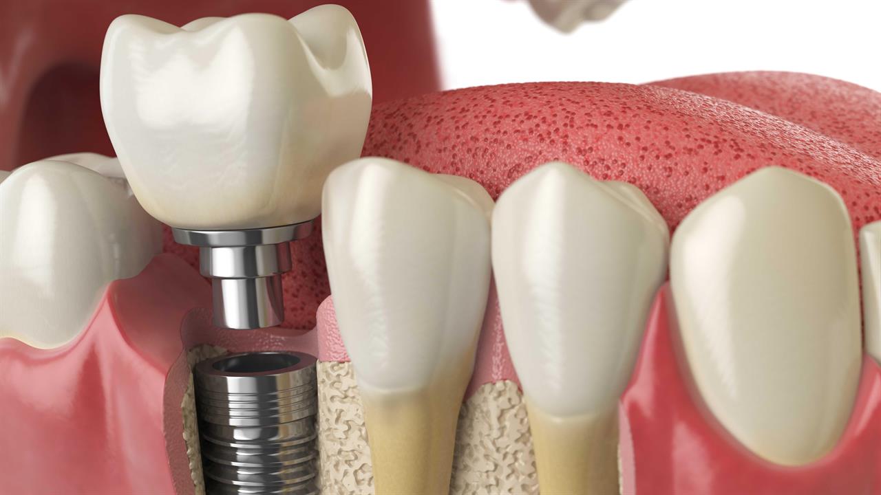 Dental implant